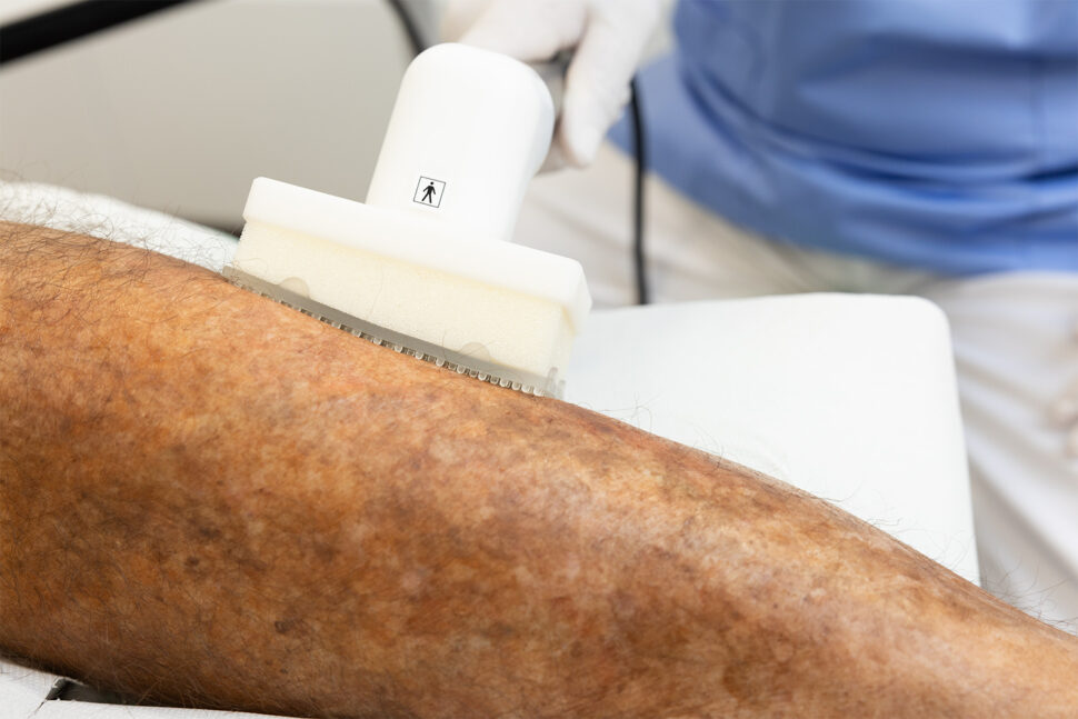 Kaltplasma-Behandlung am Unterschenkel mit dem Flex-Spacer bei flächiger Wunde wie bei Ulcus cruris